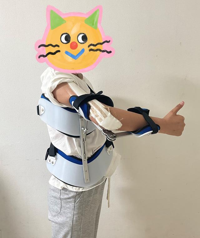 13歲少女患骨肉瘤面臨截肢，3D打印肱骨假體治療成功保肢